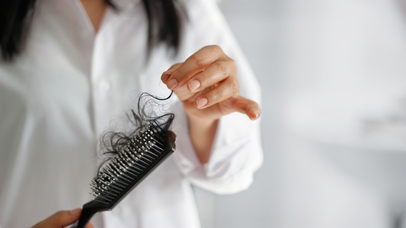Hairloss 2