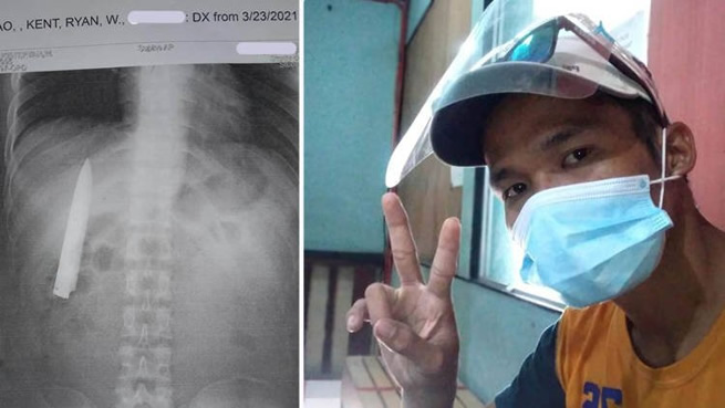 had no idea he had a knife blade stuck inside his chest for more than a year (Photo)