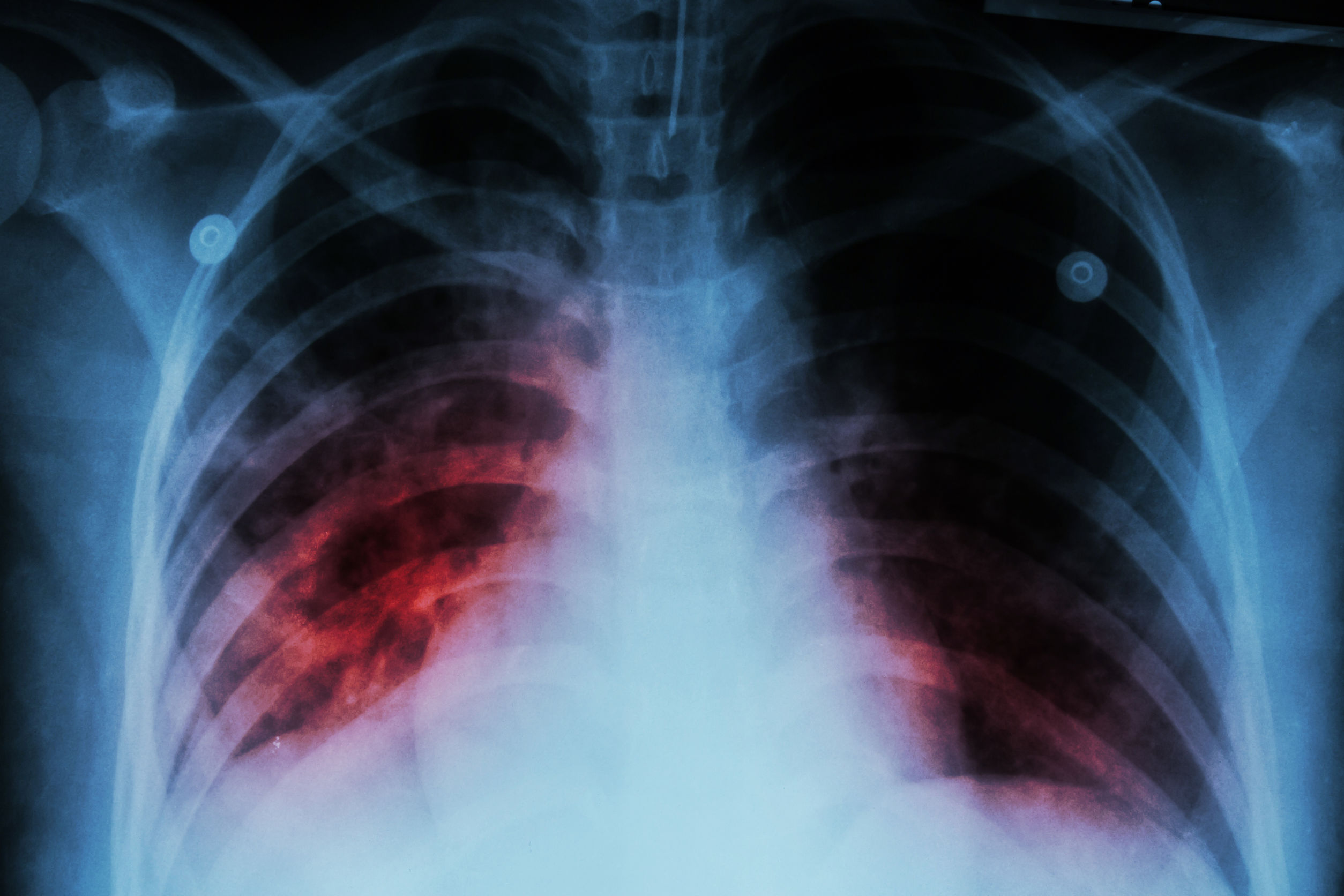 tuberculosis TB