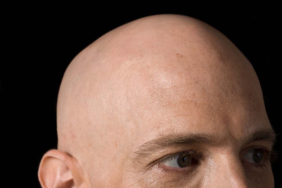 before going bald