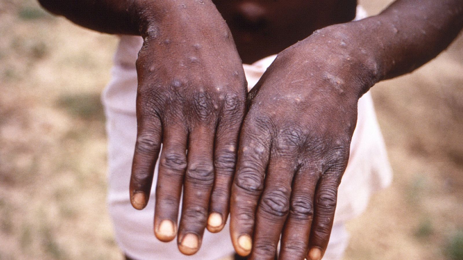 monkey pox