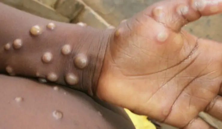 First Monkeypox