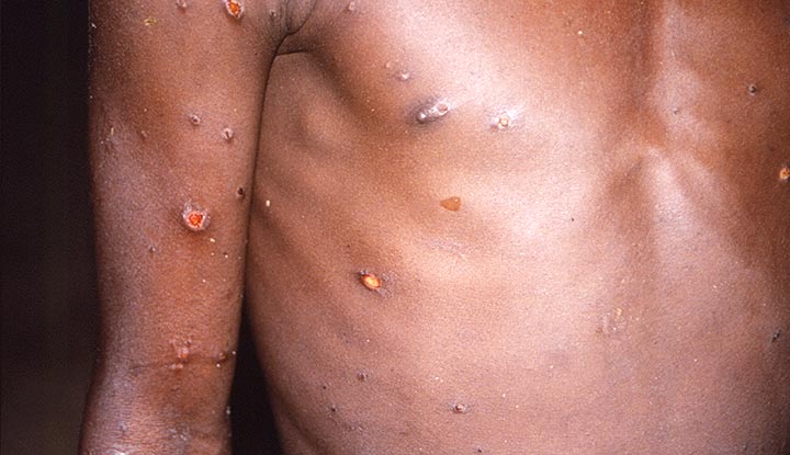 monkeypox