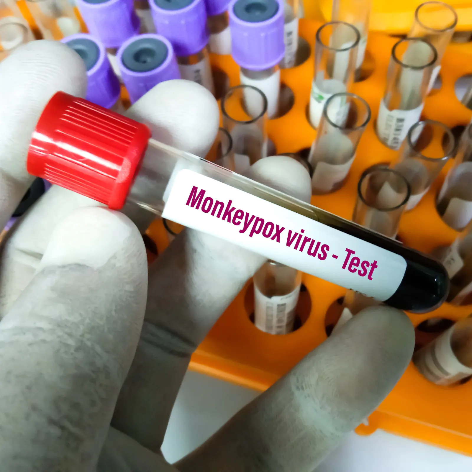 COVID and HIV