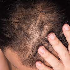 hair transplant techniques