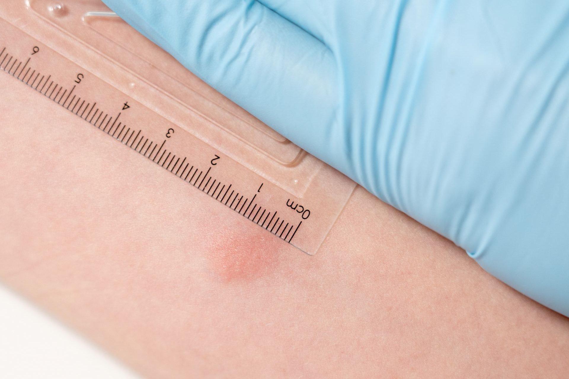 tuberculosis test