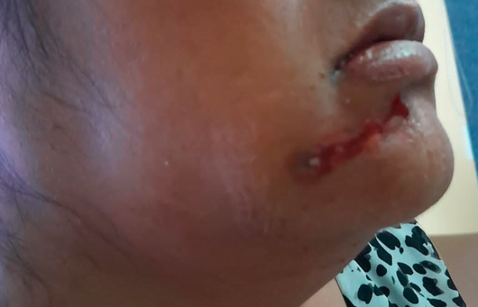 Phoenix protester to join legal battle against police after being shot in the face over water