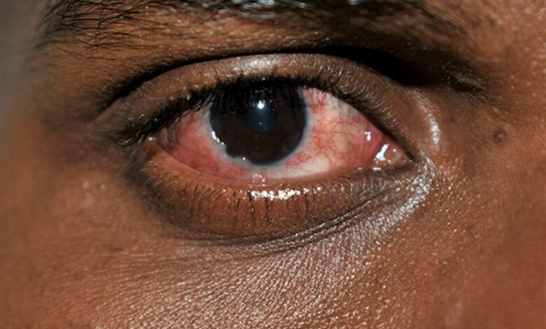 Pink Eye