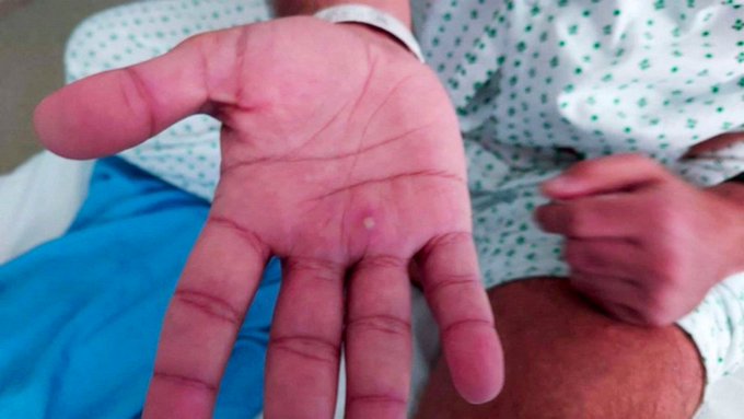 Monkeypox